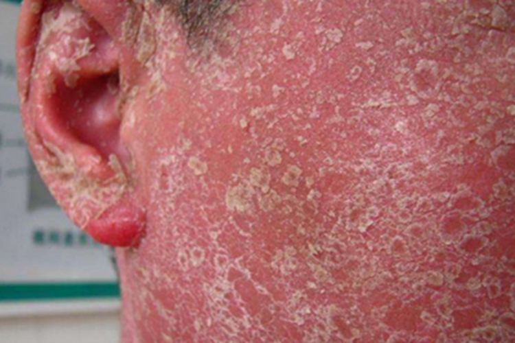 寻常型儿童银屑病面部结痂图