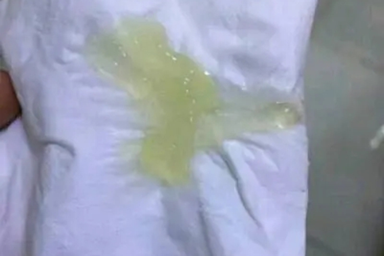 怀孕39周外阴部有果冻状分泌物图