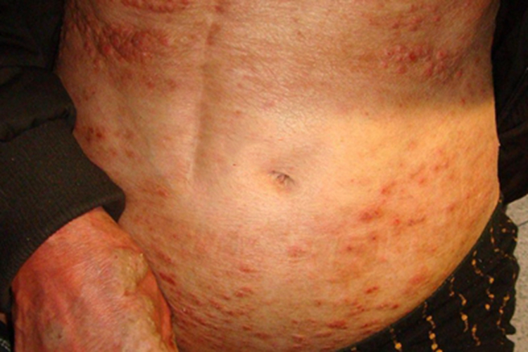 慢性光化性皮炎腹部症状图