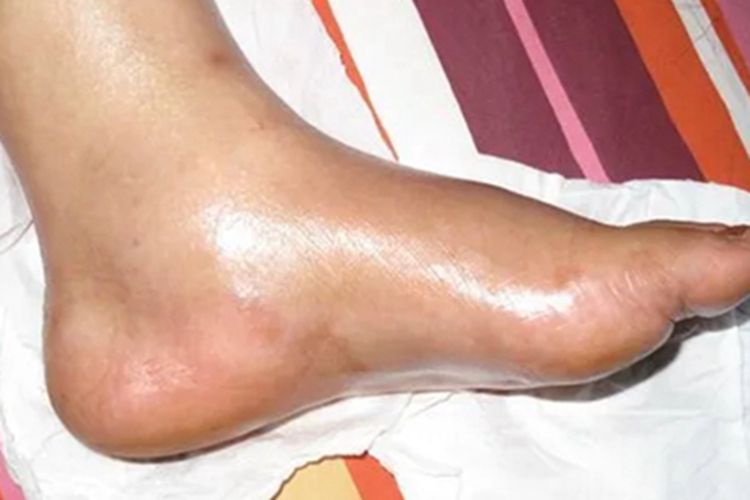 踝扭伤脚踝肿了鼓起大包图