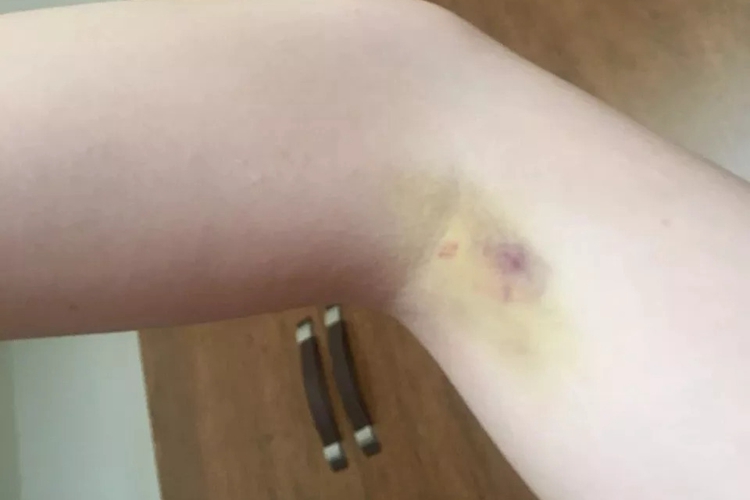 女生抽血胳膊淤青图 女生抽血胳膊淤青图