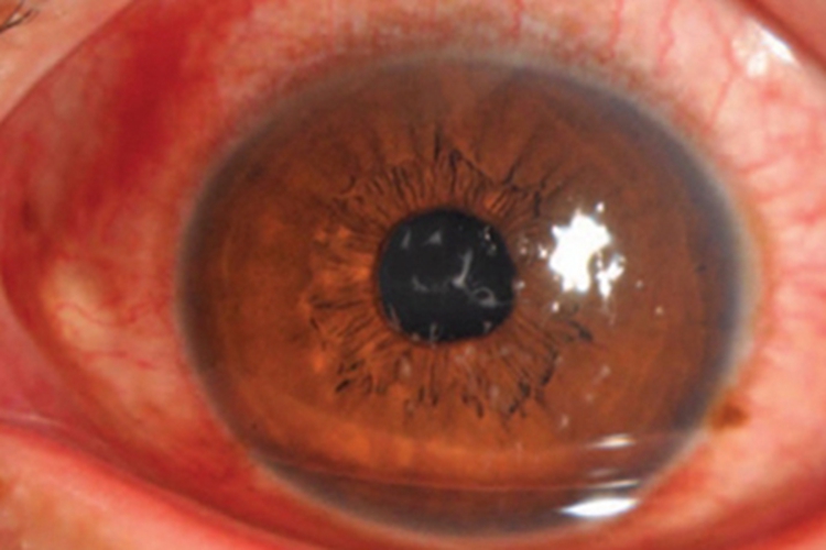 丝状角膜病变黑眼球有白点图