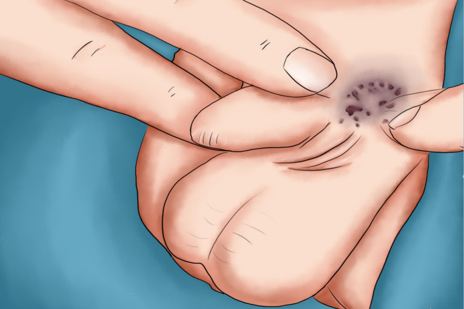 阴茎红斑样血管瘤手绘图 阴茎红斑样血管瘤手绘图