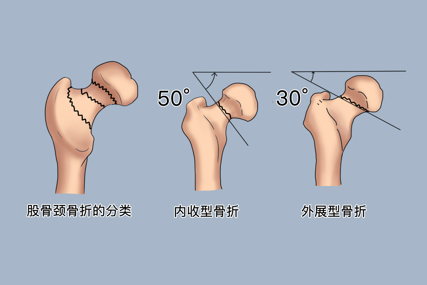 股骨颈骨折内收型外展型图