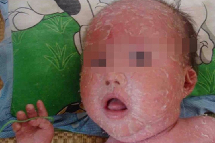 非大疱性鱼鳞病样红皮病症状图