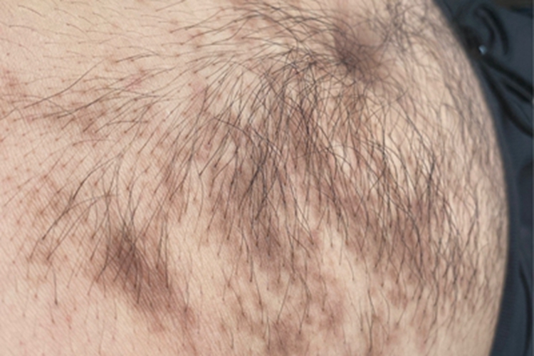 炎症后色素沉着肚子上有褐斑图