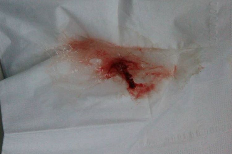 咽隐窝肿瘤回缩性血涕图