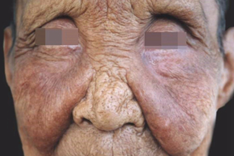 眼睑麻风脸上皮肤增厚图 眼睑麻风脸上皮肤增厚图
