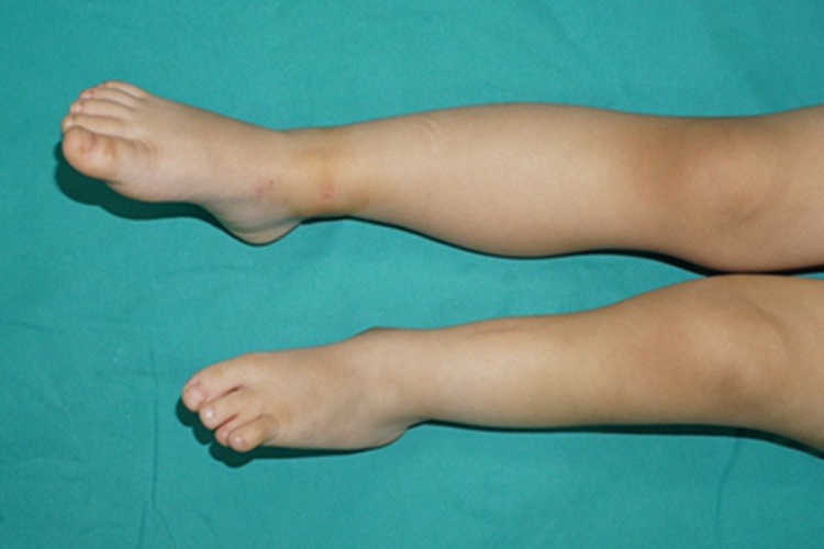 先天性腓骨缺如腿畸形图 先天性腓骨缺如腿畸形图