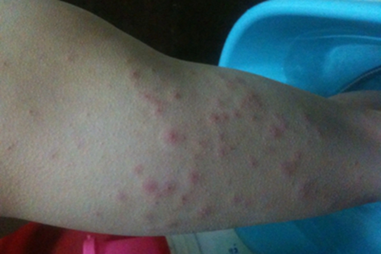 儿童期特应性皮炎小腿丘疹图 儿童期特应性皮炎小腿丘疹图