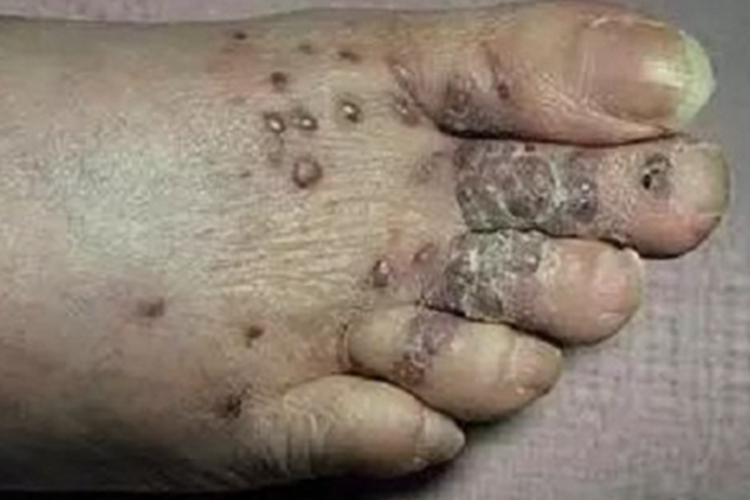 卡波西肉瘤脚背结节图 卡波西肉瘤脚背结节图