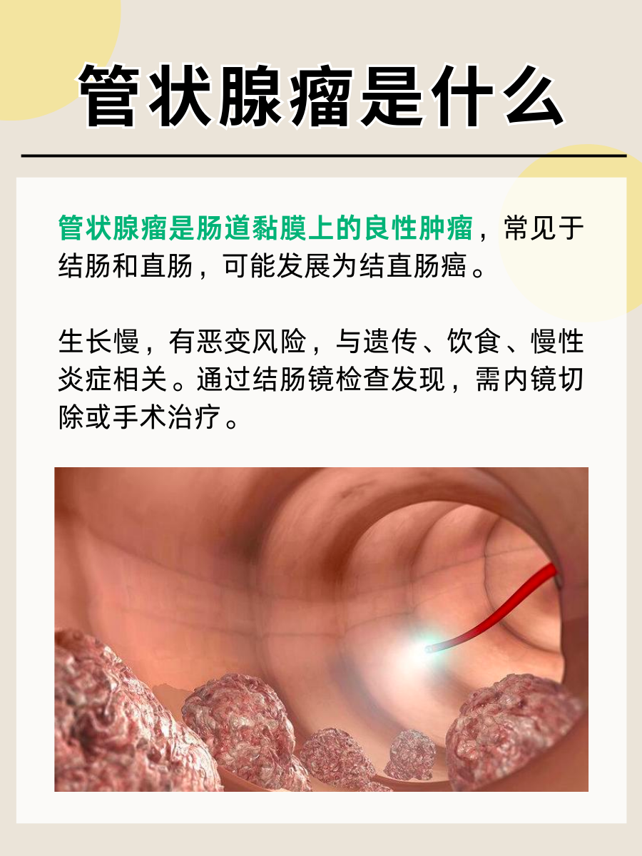 管状腺瘤是什么，常见肿瘤知识