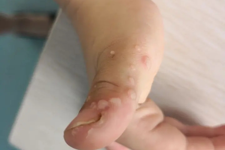 儿童手指寻常疣丘疹图