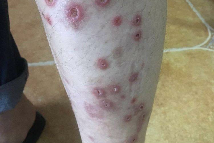 丘疹坏死性结核疹图 丘疹坏死性结核疹图