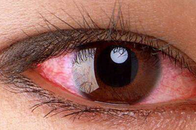 结膜炎结膜血丝图