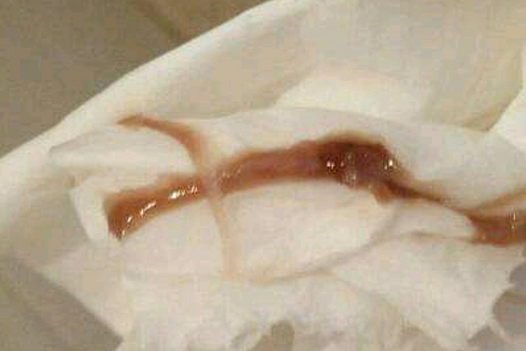 孕5个月外伤宫颈炎有血丝图