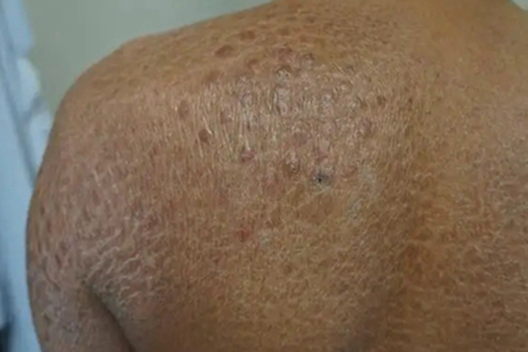 鱼鳞病背部皮肤增厚图 鱼鳞病背部皮肤增厚图