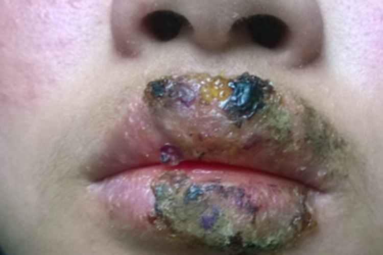 慢性唇炎嘴唇渗液结黑痂图 慢性唇炎嘴唇渗液结黑痂图