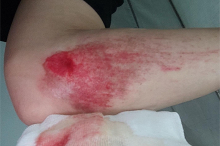 擦伤红斑图