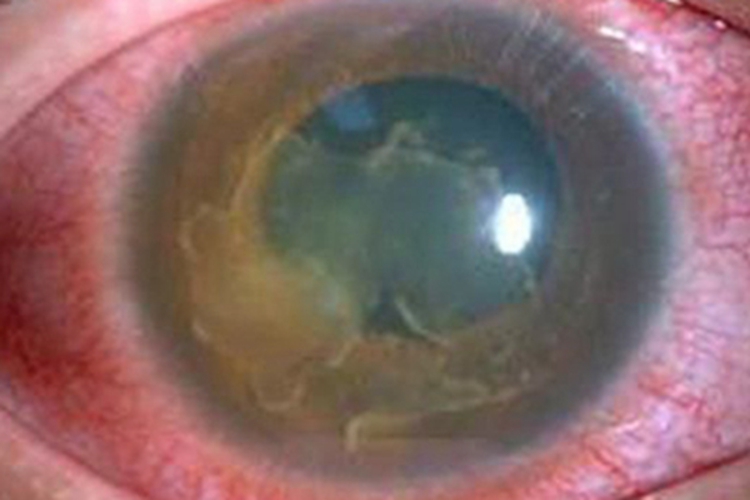 二期梅毒眼睛发红充血图