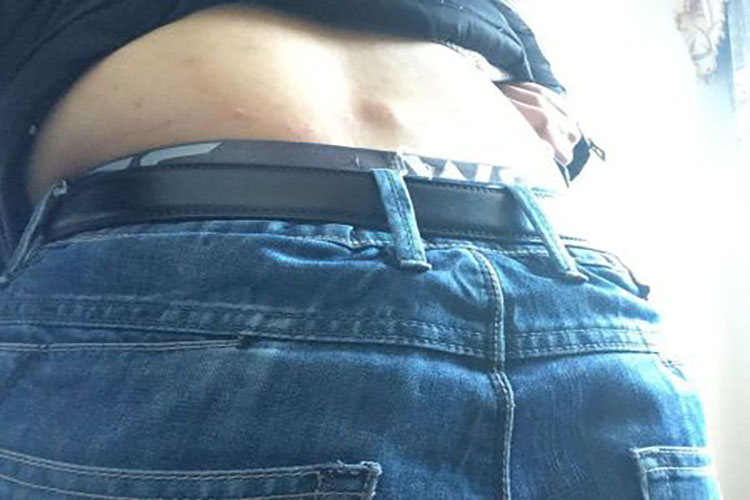 脂肪瘤图 脂肪瘤图