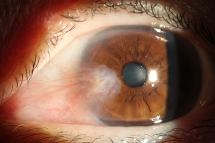 翼状胬肉症状图