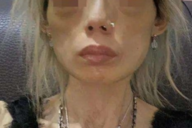 进行性脂肪营养不良面部症状图