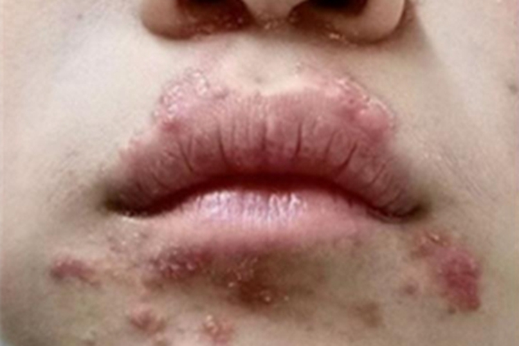 口周皮炎口周疙瘩图