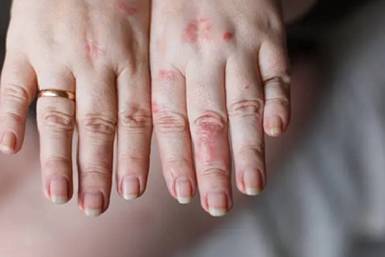1级手足综合征红斑图