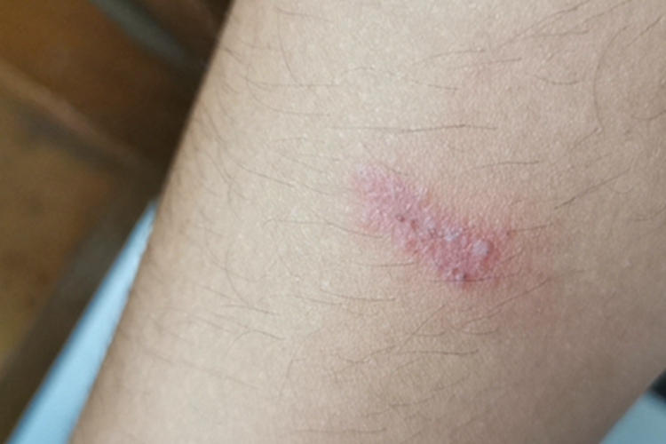 隐翅虫皮炎胳膊症状图