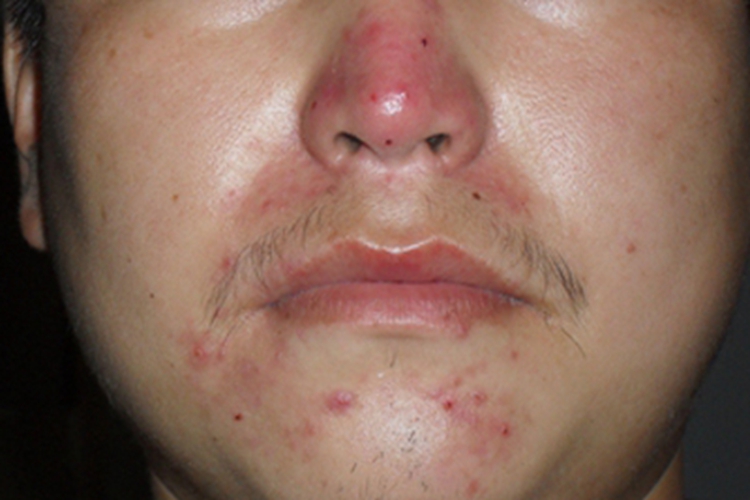 丘疹脓疱型酒糟鼻鼻部红斑图