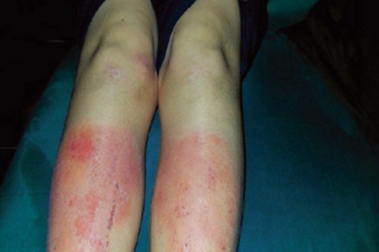 儿童期特应性皮炎小腿红斑图 儿童期特应性皮炎小腿红斑图