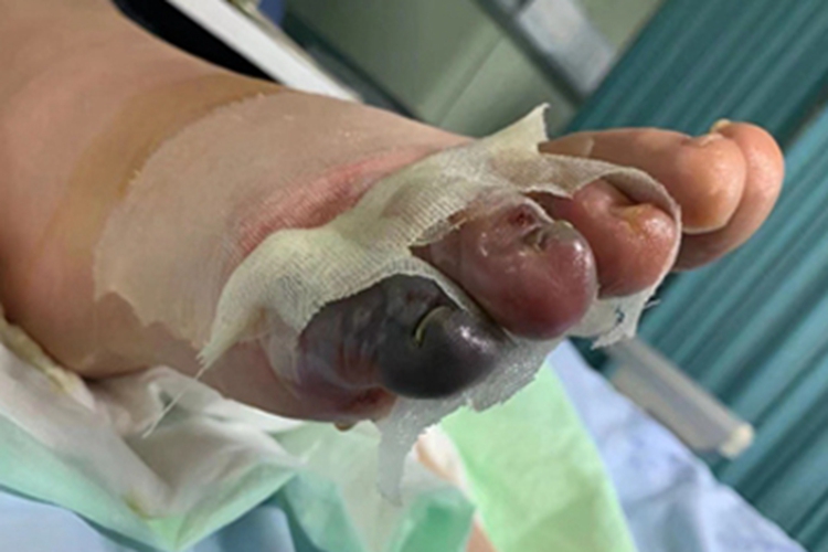 浸渍足脚趾发黑坏死图