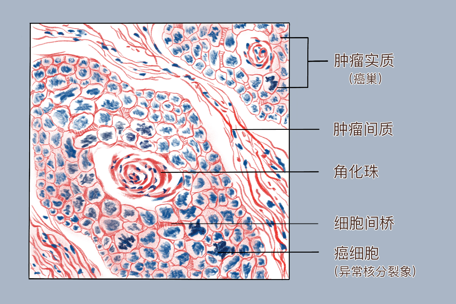 皮肤鳞状细胞癌红蓝铅笔绘图