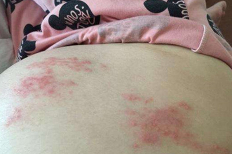 妊娠疱疹丘疹图