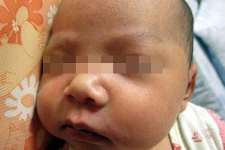 宝宝鼻子周围原发性粟丘疹图