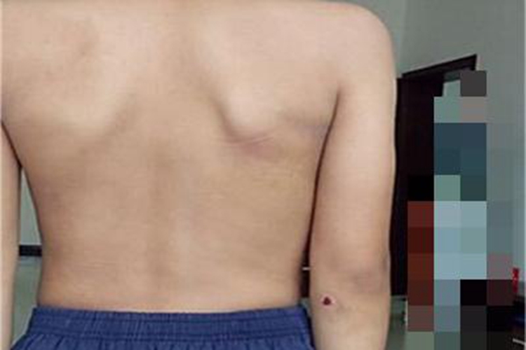 青少年型特发性脊柱侧弯变形图 青少年型特发性脊柱侧弯变形图