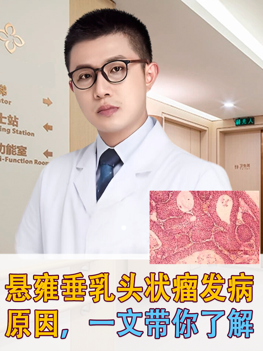 悬雍垂乳头状瘤发病原因，一文带你了解