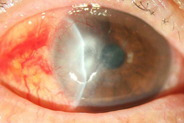 慢性细菌性结膜炎结膜充血图