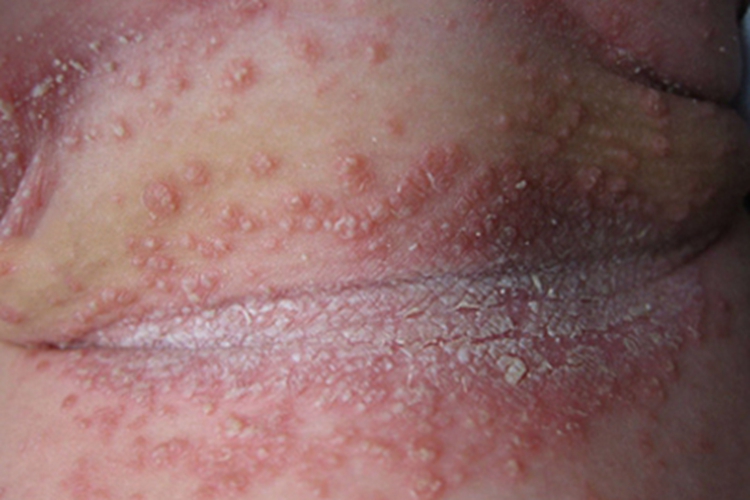 念珠菌性间擦疹前颈脱屑图