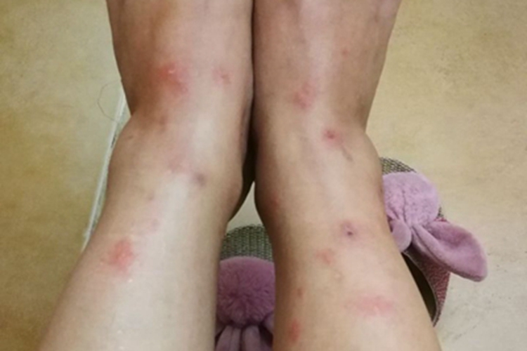 跳蚤叮咬脚踝小水疱图 跳蚤叮咬脚踝小水疱图