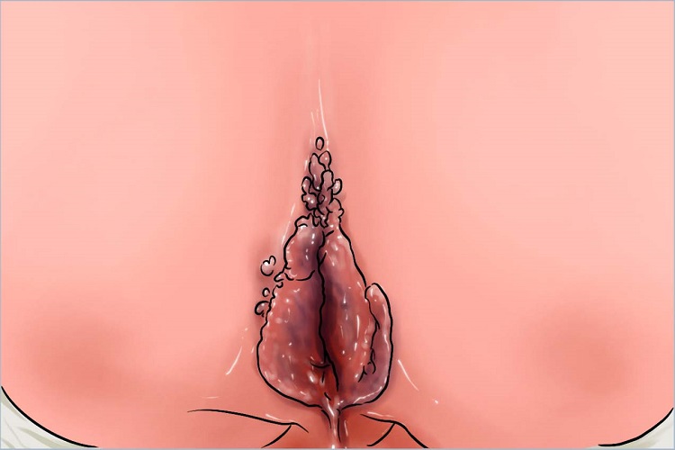 肛周巨大尖锐湿疣肛周症状图