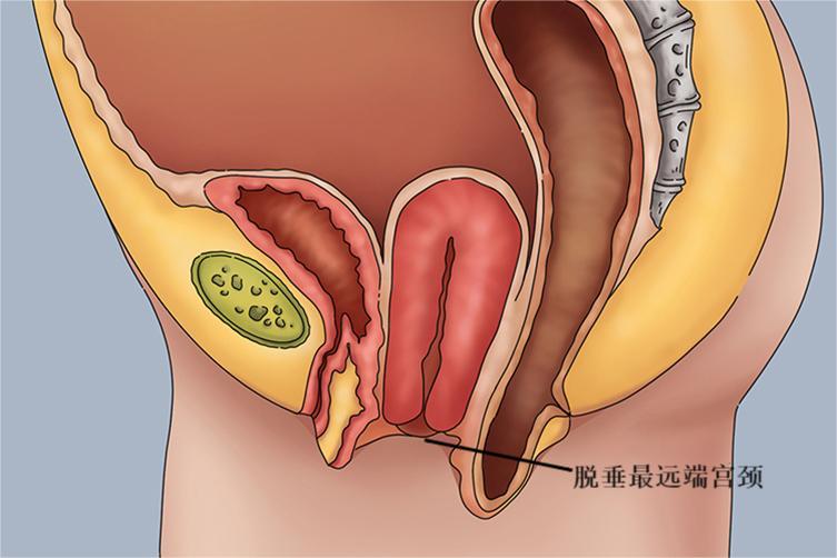 Ⅰ度子宫脱垂阴道手绘图 Ⅰ度子宫脱垂阴道手绘图