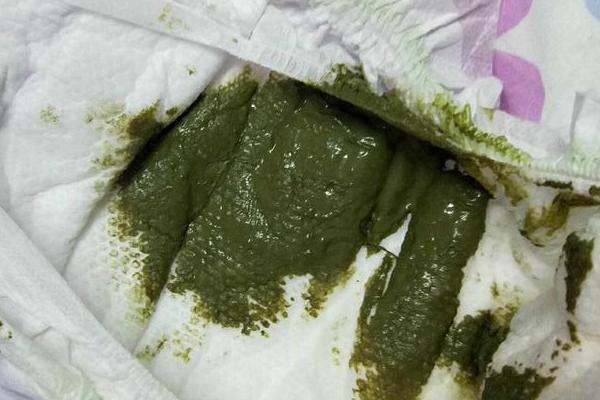 母乳喂养不足婴儿大便深绿色图