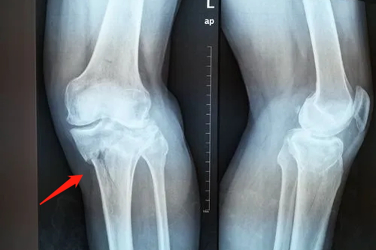 胫骨平台骨折位置图