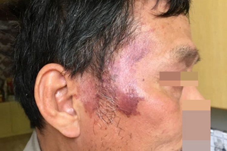 特发性头颈部血管肉瘤紫斑图 特发性头颈部血管肉瘤紫斑图
