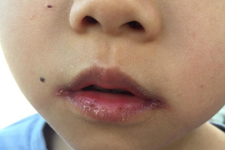 接触性口角炎图