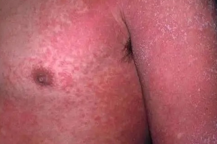 儿童猩红热皮损图