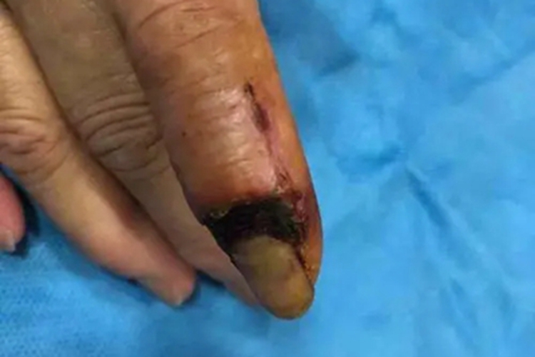 冷凝集素综合征手指症状图 冷凝集素综合征手指症状图