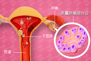 多囊卵巢.gif